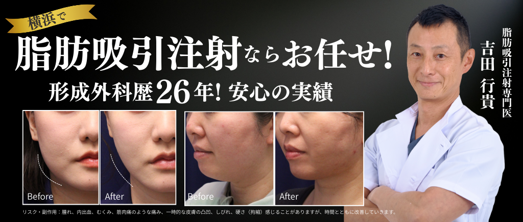 脂肪吸引注射ならお任せ！