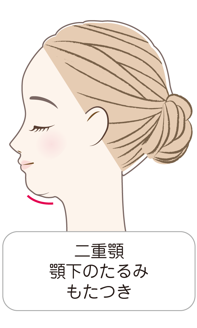 二重顎・顎下のたるみ・もたつき