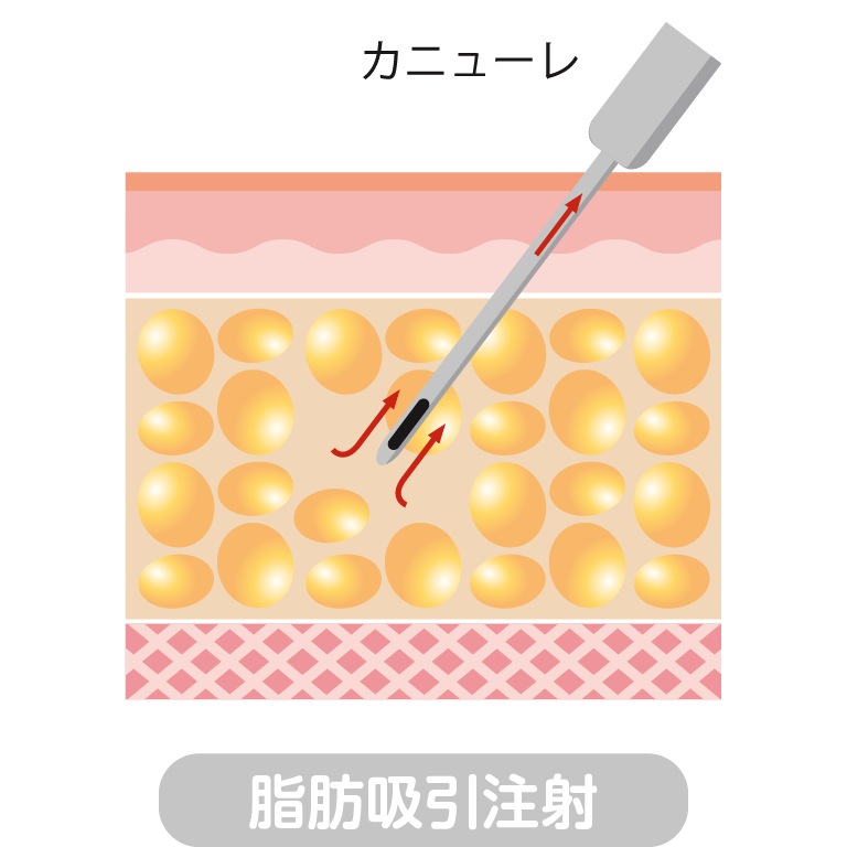 脂肪吸引注射