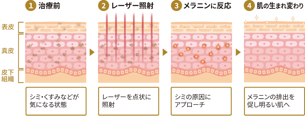 ルビーフラクショナルの治療の流れ（1.治療前／2.レーザー照射／3.メラニンに反応／4.肌の生まれ変わり）