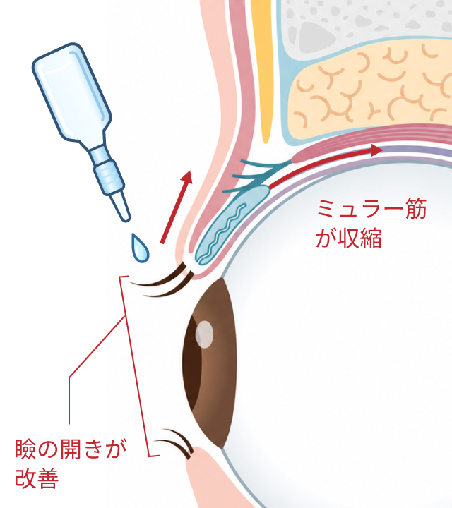 アップニーク点眼後にまぶたの開きが改善した状態の断面図