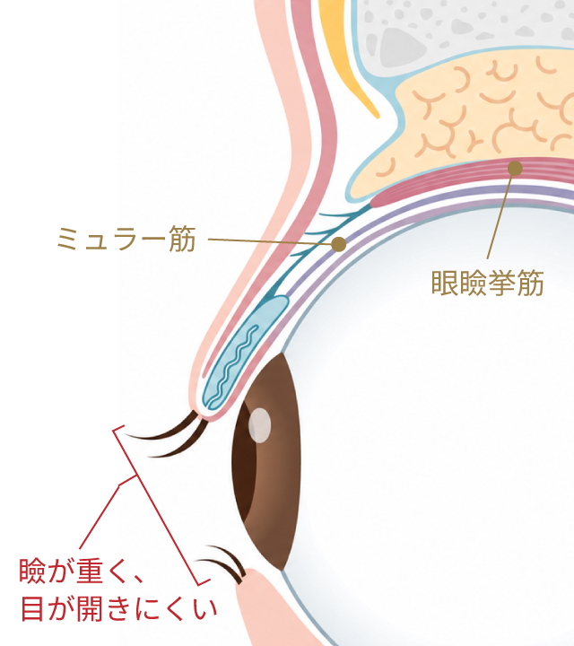 軽度の眼瞼下垂で目が開きにくい状態の断面図